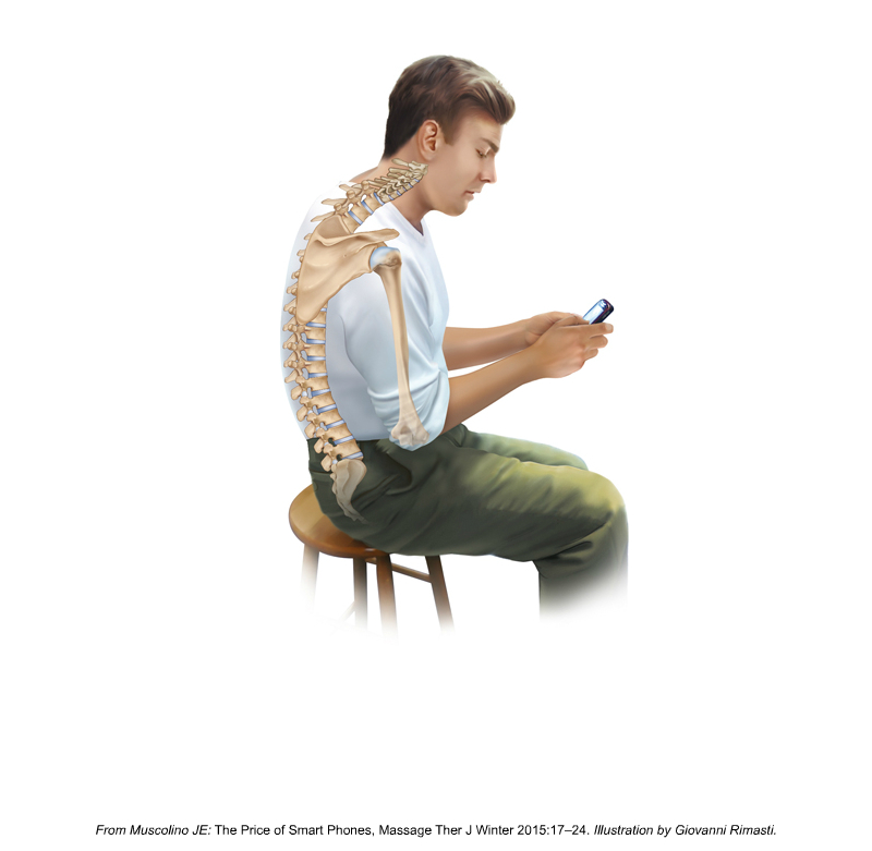 Thoracic Hyperkyphosis. Permission Dr. Joe Muscolino.